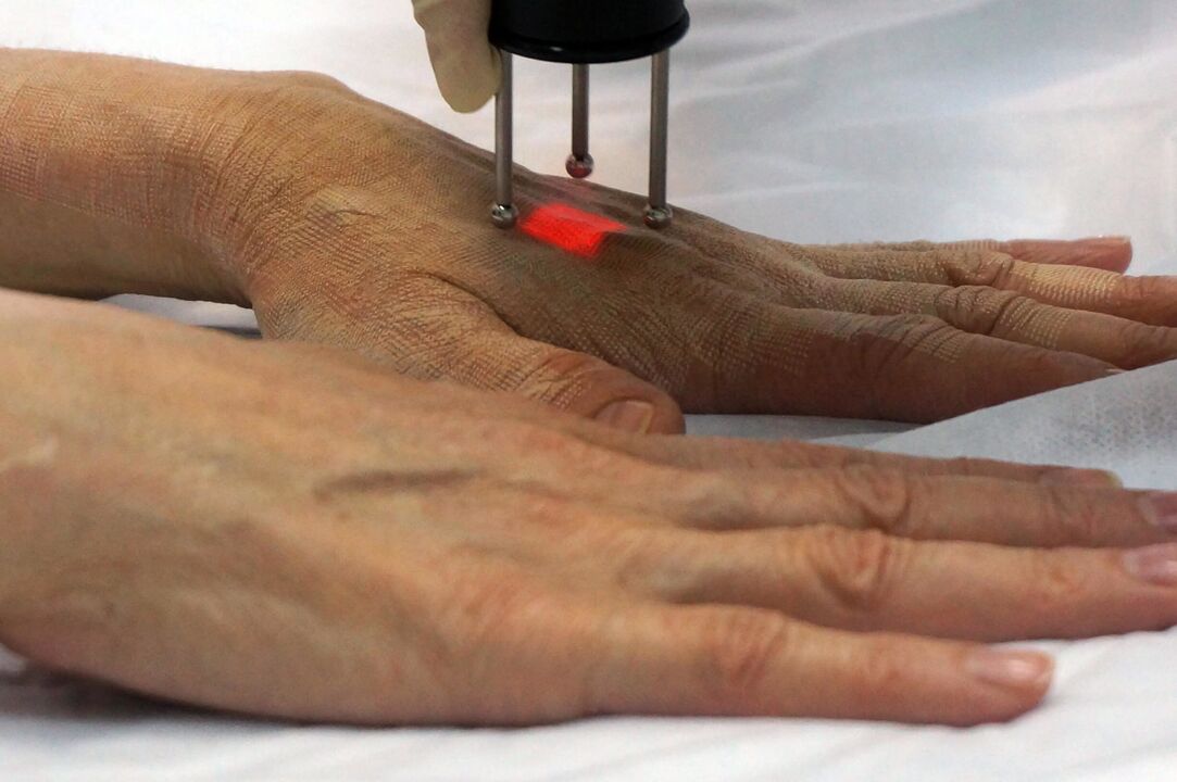Rajeunissement laser des mains avec une méthode non ablative
