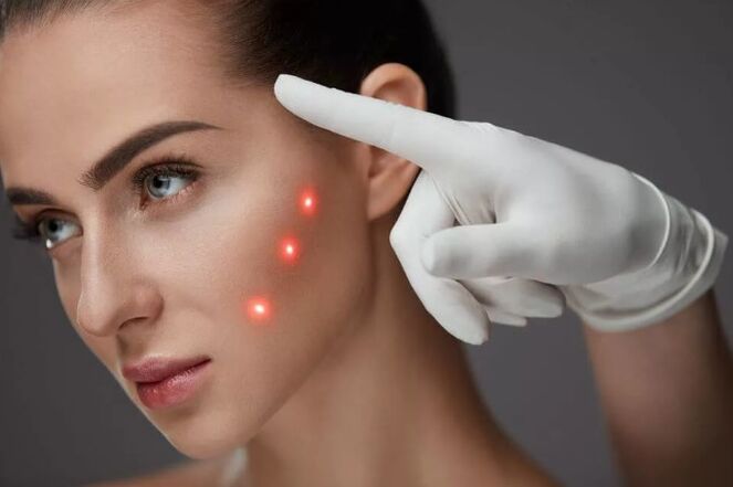 Rajeunissement au laser de la peau
