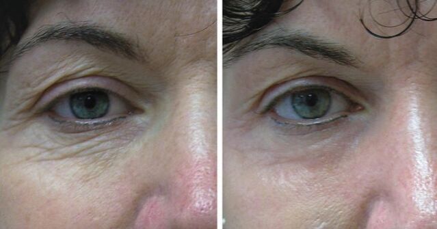 Laser de peau autour des yeux