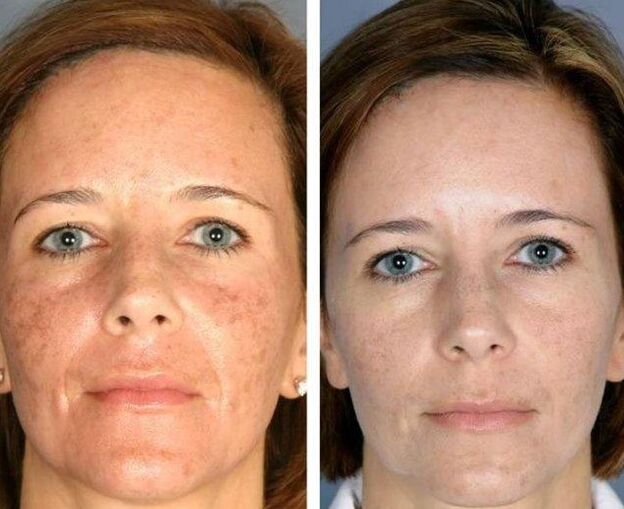 Rajeunissement au laser