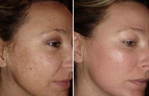 rajeunissement de la peau du visage au laser avant et après les photos